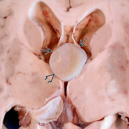 Nang keo não thất ba (Colloid cysts of the third ventricle)