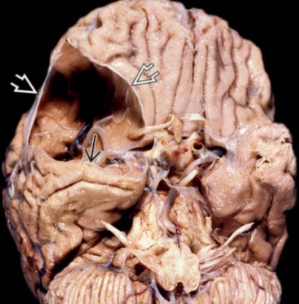 Nang màng nhện (Arachnoid Cyst)