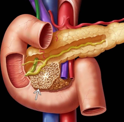 U nang tuyến thanh dịch của tụy (Serous Cystadenoma of the Pancreas)