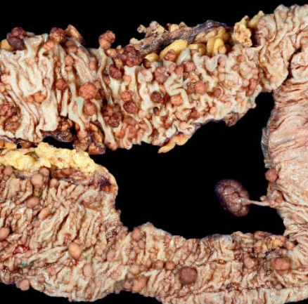 Hội chứng Turcot (Turcot Syndrome -TS)