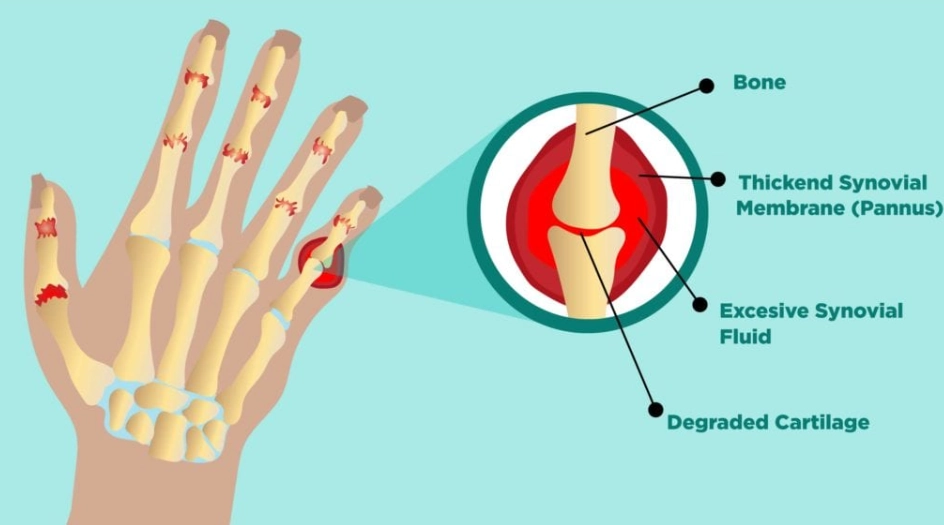 Thoái hóa khớp bàn tay (Osteoarthritis of the hand)