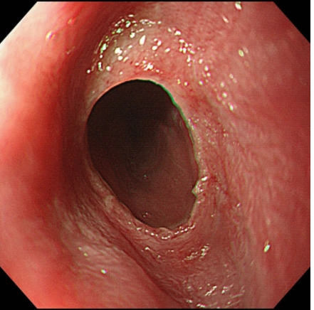MÀNG NGĂN THỰC QUẢN (ESOPHAGEAL WEBS)