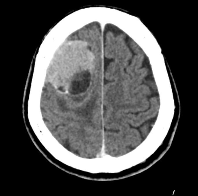U màng não không điển hình (Atypical Meningioma)