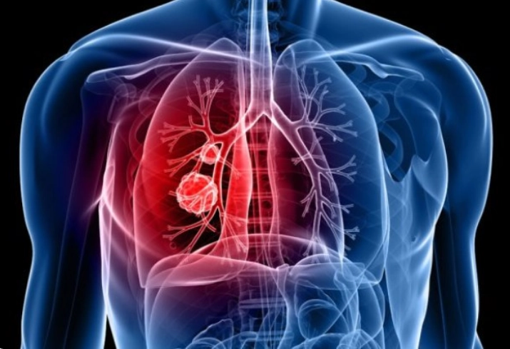 Viêm phổi do phế cầu (Pneumococcal Pneumonia)