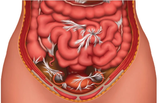 Dính ruột trong ổ bụng (Abdominal Adhesions)