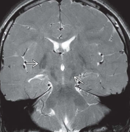 Bệnh não ty thể (Mitochondrial Encephalopathies -ME)
