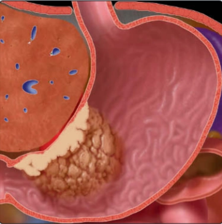 Ung thư biểu mô tuyến dạ dày (Gastric adenocarcinoma)