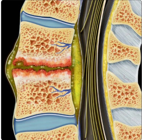 Bệnh lý tủy sống