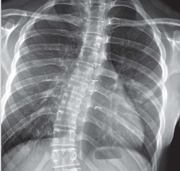 Bệnh lý cơ xương khớp ở thanh thiếu niên