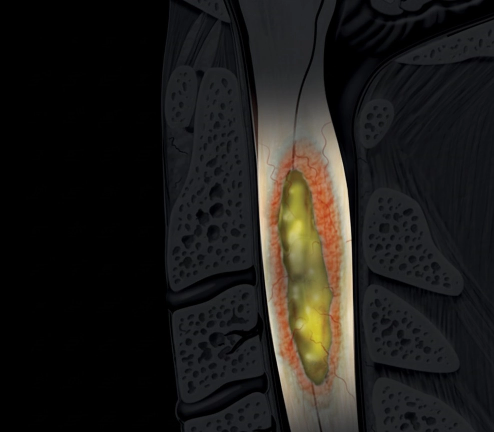 Viêm nhiễm cột sống