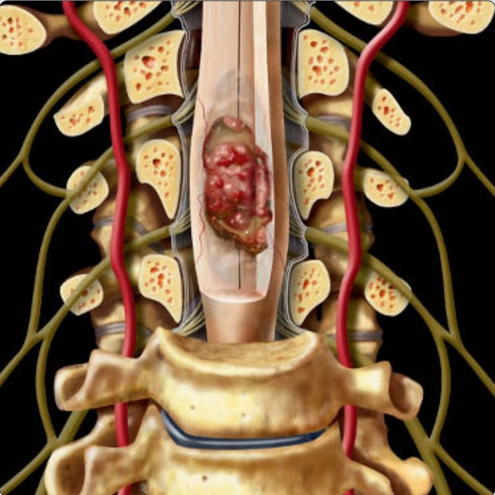 Khối u cột sống