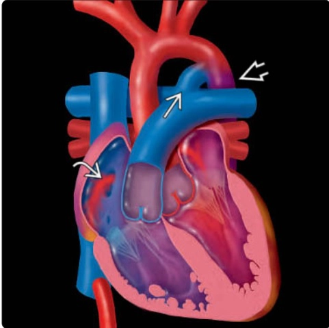 III. Bệnh lý tim thai