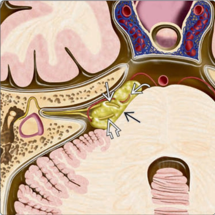 Góc cầu tiểu não  (CPA)