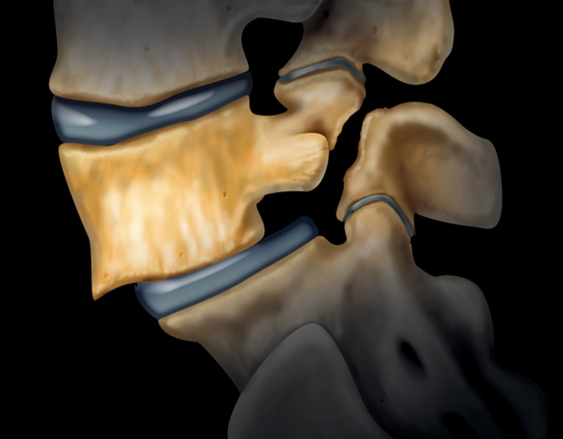 Thoái hóa cột sống
