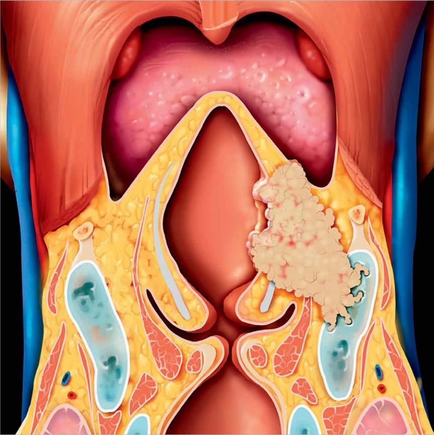 Họng, Thanh quản và Viêm nhiễm Sâu