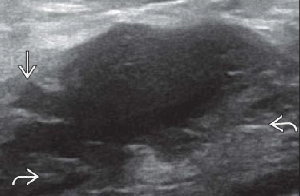 Tổn thương ác tính