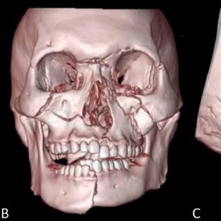 Chấn thương hàm mặt