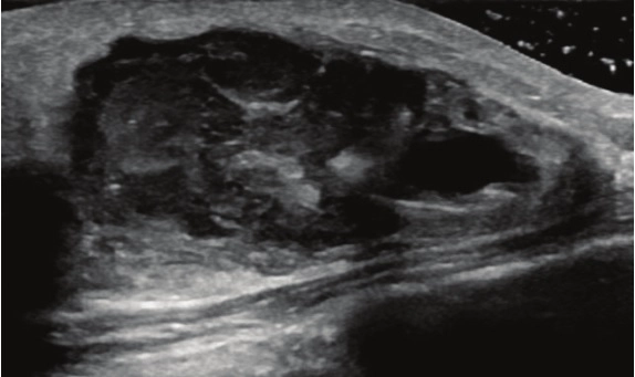 Viêm nhiễm tuyến vú