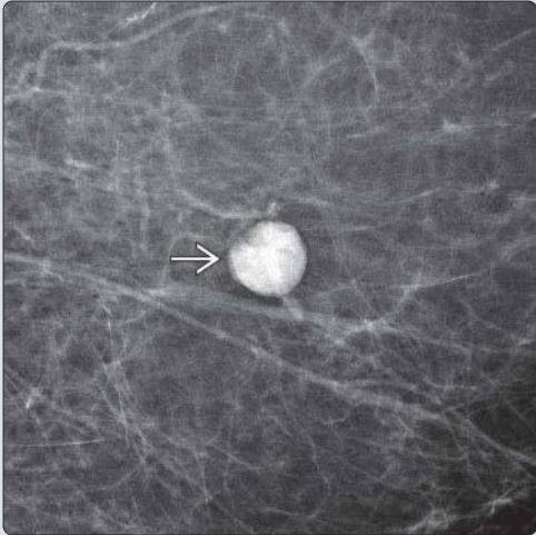 Tổn thương lành tính