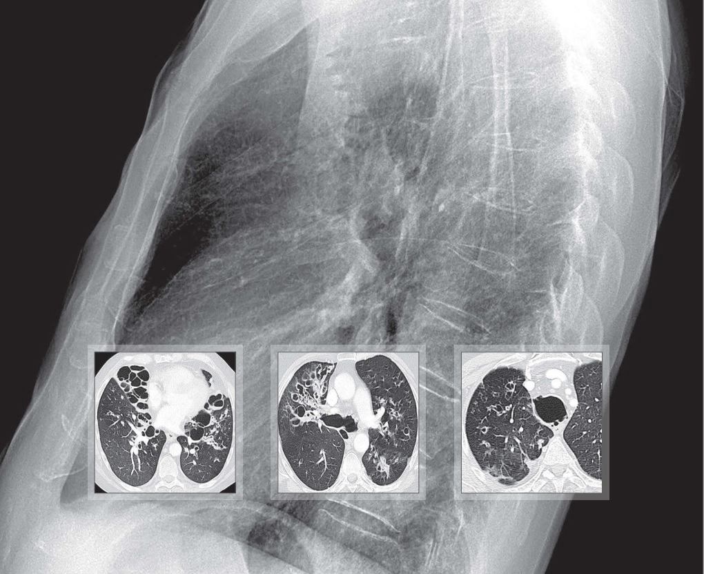 Bệnh lý đường thở (khí phế quản)