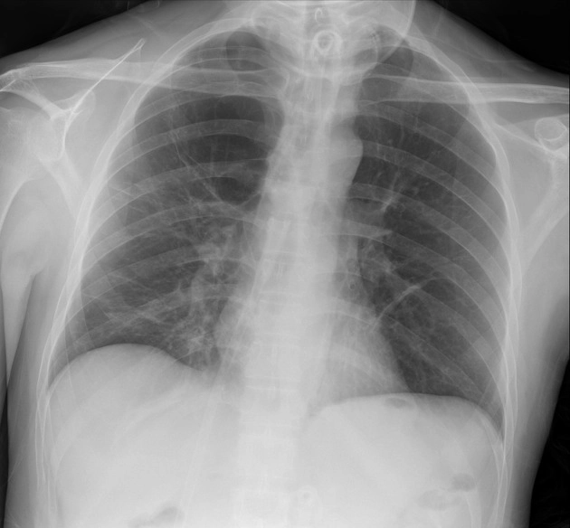 Các biểu hiện ở phổi do sử dụng chất gây nghiện (Illicit Drug Use, Pulmonary Manifestations)