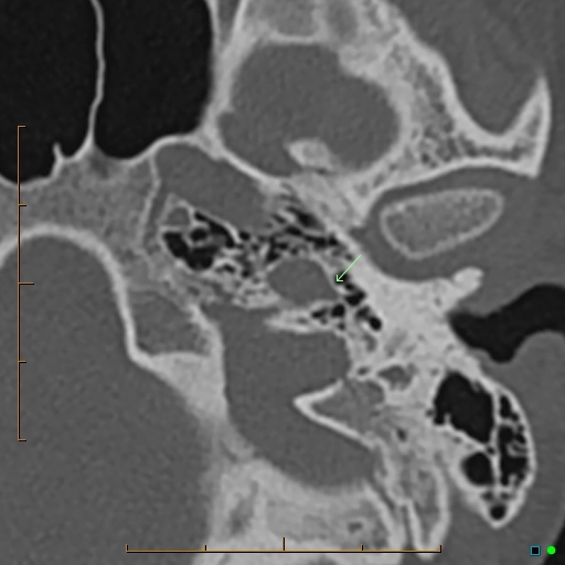 Tồn tại động mạch bàn đạp (Persistent stapedial artery - PSA)