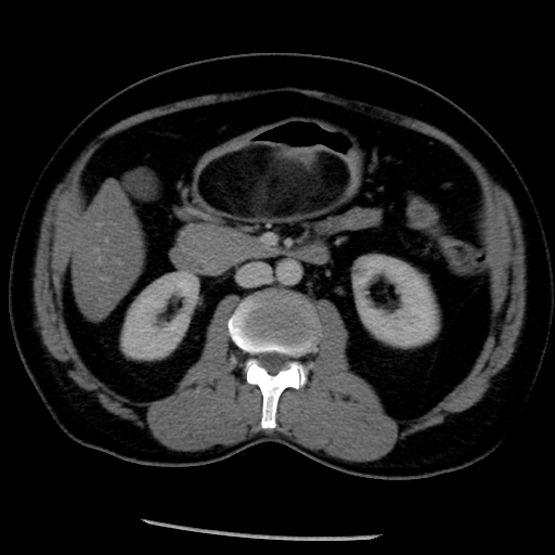 U mỡ dạ dày (Gastric lipoma)
