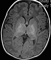 Bệnh não do thiếu oxy-thiếu máu cục bộ ở trẻ sơ sinh (Neonatal Hypoxic-Ischemic Encephalopathy - HIE)