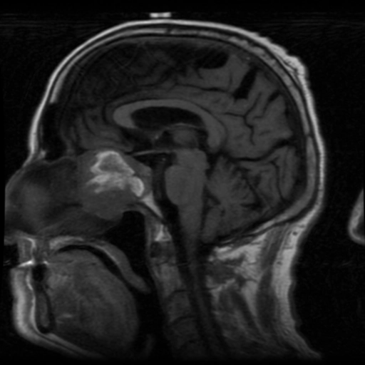 Melanoma niêm mạc mũi xoang (Sinonasal mucosal melanomas)