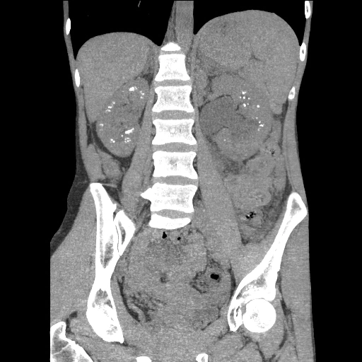 Vôi hóa thận (Nephrocalcinosis)