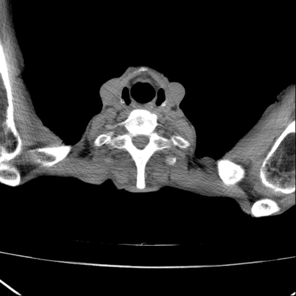 Di căn phổi hình bong bóng (Cannonball Metastases)