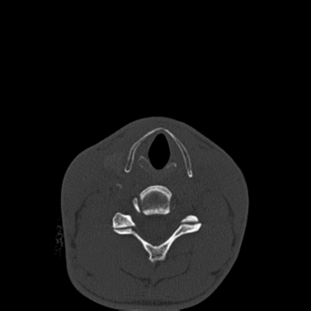 Gãy phức hợp gò má - hàm trên (Zygomaticomaxillary complex fracture)