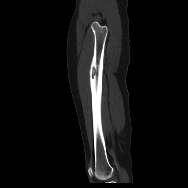 Lao xương (Tuberculous osteomyelitis)