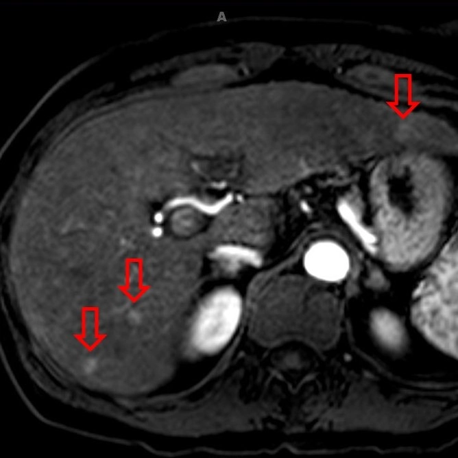LI-RADS phân loại gan (CT/MRI LI-RADS v2018 - CT/MRI Liver Imaging Reporting and Data System)