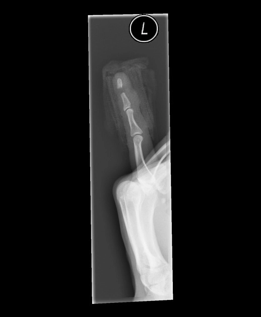 Gãy đốt xa xương ngón tay (Distal phalanx fracture)