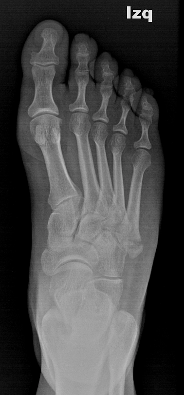 Gãy bong lồi củ xương bàn chân số 5 (pseudo-Jones fracture)
