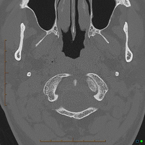 U cuộn cảnh (Jugular paraganglioma)