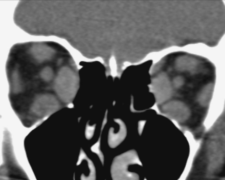 Bệnh mắt do tuyến giáp (Thyroid-associated orbitopathy - TAO)