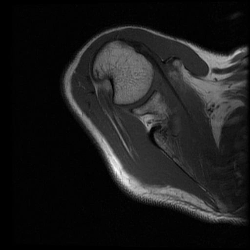 Tổn thương GAGL (Glenoid Avulsion of the Glenohumeral Ligament) 