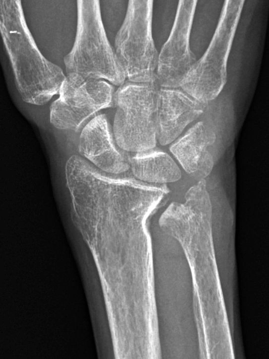 Hội chứng chèn ép xương trụ (Ulnar impingement syndrome)