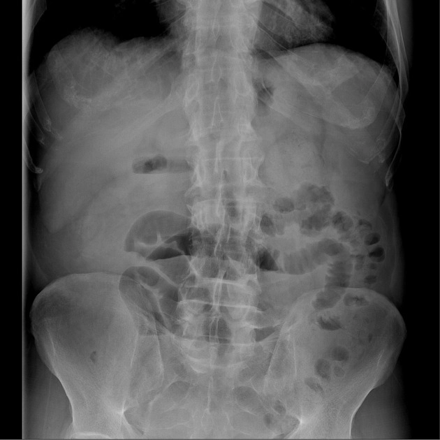 Viêm khớp liên quan đến bệnh ruột (Enteropathic arthritis - EA)