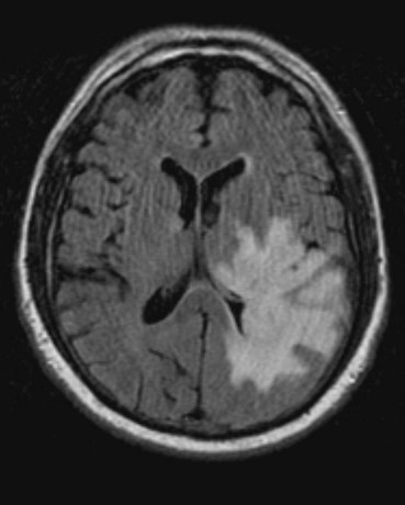 Viêm não/Bệnh não do HIV (HIVE)