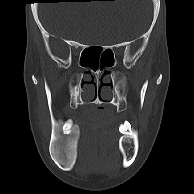 U xơ hóa xi măng xương hàm (Cemento-ossifying fibroma - COF)