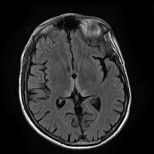 Bệnh não do rượu (alcoholic encephalopathy)/ Hội chứng Wernicke-Korsakoff (Wernicke-Korsakoff syndrome)