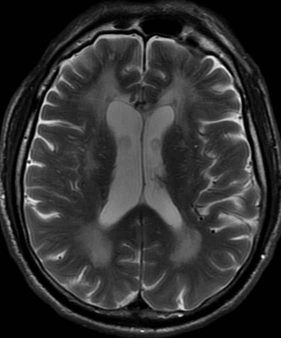 Sa sút trí tuệ liên quan HIV (HIV-associated dementia - HAD)