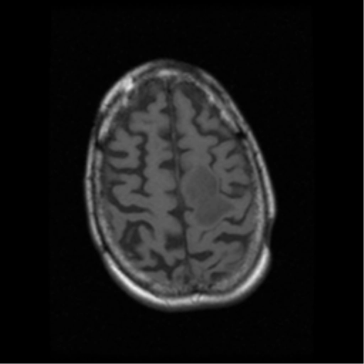 U thần kinh đệm do xạ trị (Radiation-induced gliomas)