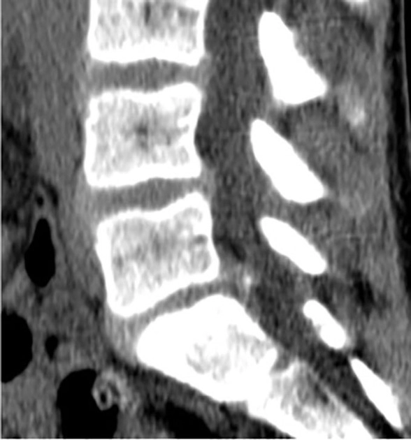 Gãy sụn viền cung sau (Posterior ring apophyseal fracture)