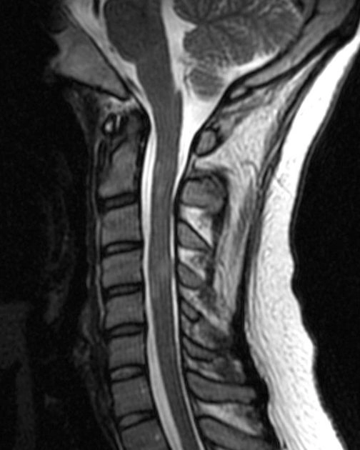 Xơ cứng rải rác ở tủy sống (Spine multiple sclerosis)