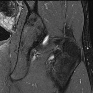 Độ nghiêng trước cổ xương đùi (Femoral anteversion)