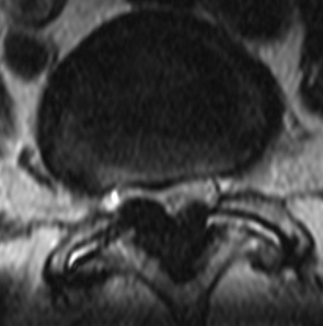 Phì đại dây chằng vàng (Ligamentum flavum hypertrophy)